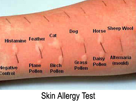 allergic reaction rash. A history of such reactions is