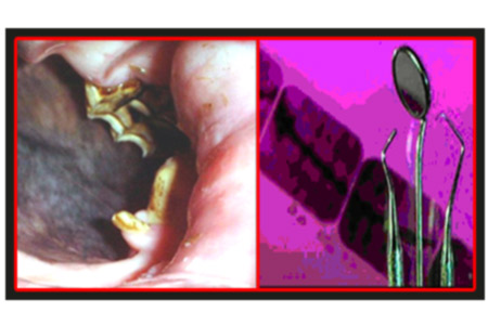 remedies tooth abscess