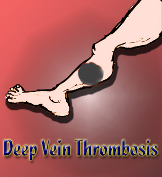 leg pain blood clot  symptoms