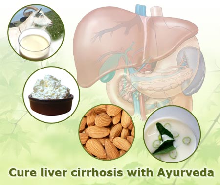 Liver Cirrhosis is known as yakrit vriddhi in ayurveda.