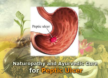 Location of Peptic Ulcers - Gastric Ulcer (Peptic Disease, Stomach Ulcer, 