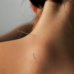 Acupuncture for Neck Pain