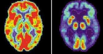 PET Scans shwoing normal brain and Brain with Alzheimer's Disease