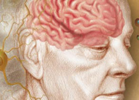 Image of Alzheimer's Affected Man