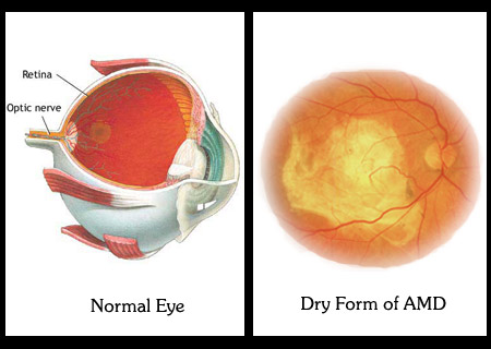 Normal eye, retina with AMD
