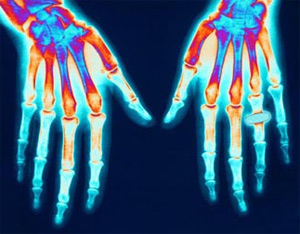Arthritis Hands