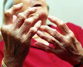 Arthritis Patient's Hands