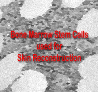 Bone marrow stem cells