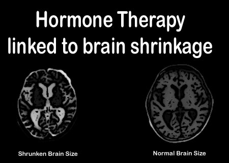Hormone Therapy results in small brain