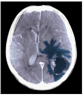 A brain tumor scan