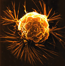  A Breast Cancer Cell