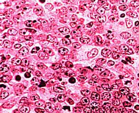 Burkitt Lymphoma Blood Cells