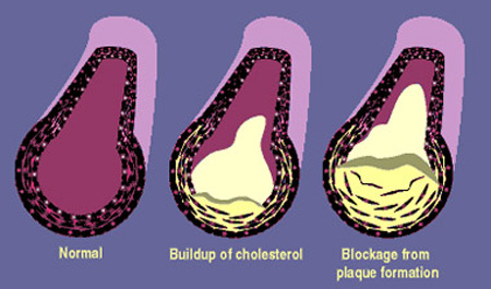 Cholesterol Build-up