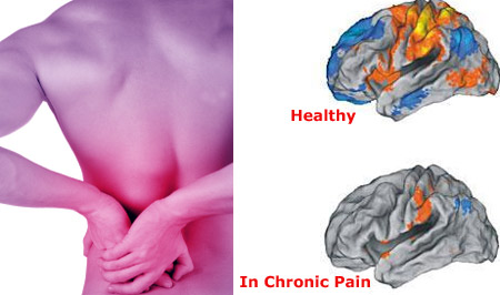 Chronic Pain damages Brain Functions