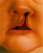 A cleft lip structure
