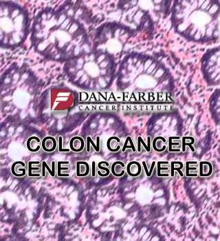 Colon cancer,dfc
