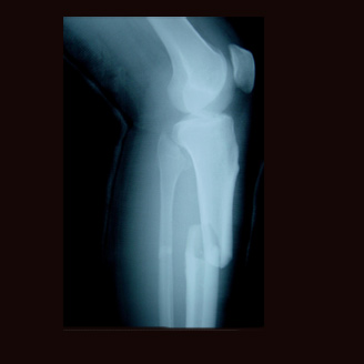 Fracture X-ray