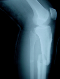 An X-ray of a Fractured Leg