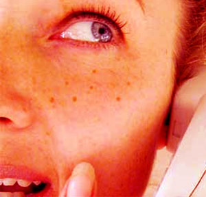 Freckled Woman