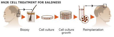 Hair Cell Treatment for Baldness