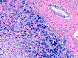 Hemochromatosis (high) Slide