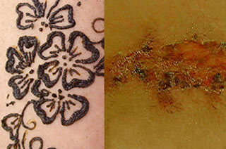 Henna, Allergy