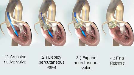 Transcatheter Aortic Valve Replacement System