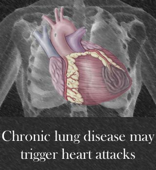 Lung disease heart attack