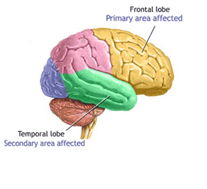 Brain with Memory Loss