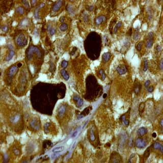 Melanoma cancerous cells