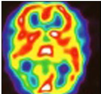 Migraine Brain Scan