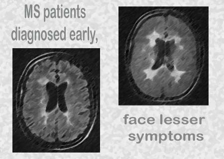 MRI scans of MS