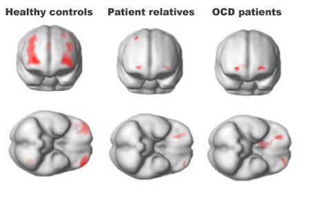 Normal and OCD brains