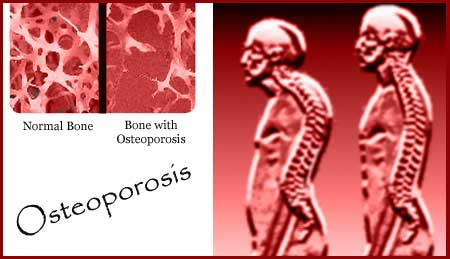 Osteoporosis, Skeletal structure