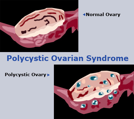 Mock image of Ovaries and Text