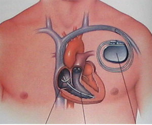Heart Pacemaker