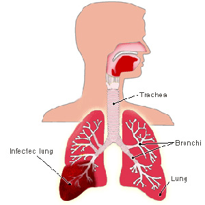 Pneumonia Diagram