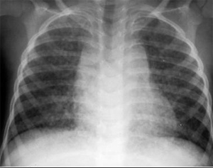 Pneumonia X-Ray
