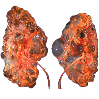 A PKD affected kidney