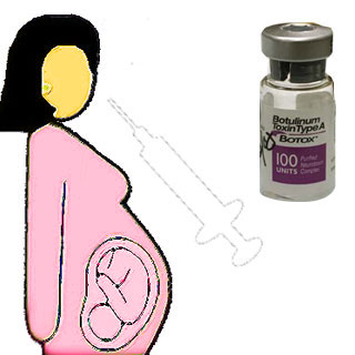 Pregnant lady and Botox intection