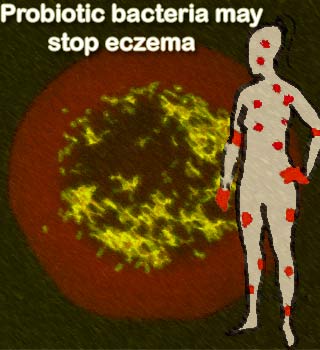 Probiotic bacteria,Eczema