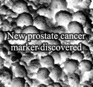 Prostate cancer cells