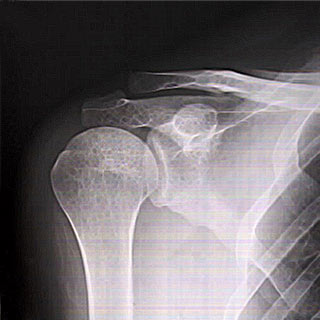 Rotator Cuff Tendonitis Shoulder X-Ray