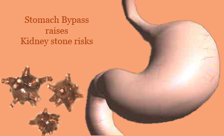 Stomach, Kidney stones
