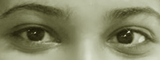 Eyes with strabismus