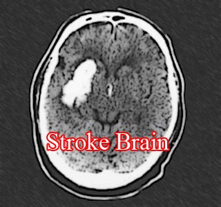 Scan of stroke brain