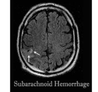 Subarachnoid Hemorrhage 