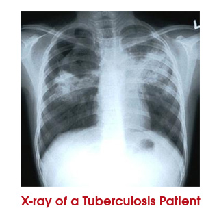 TB Patients X-Ray image