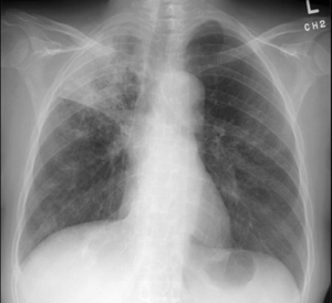 Tuberculosis Xray