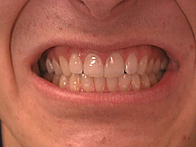 A Man's set of Teeth